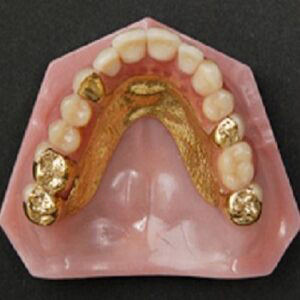 コーヌス・テレスコープ義歯