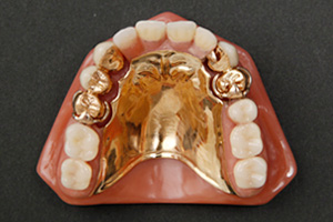 金属床義歯3