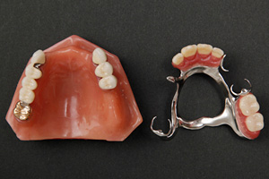 金属床義歯4