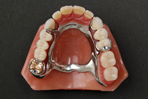 金属床義歯5